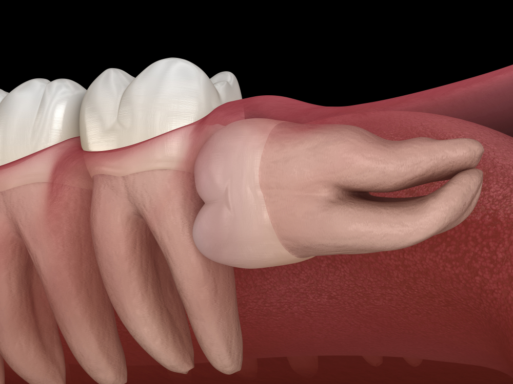 wisdom teeth removal in colleyville