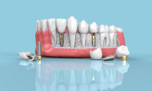 dental implants