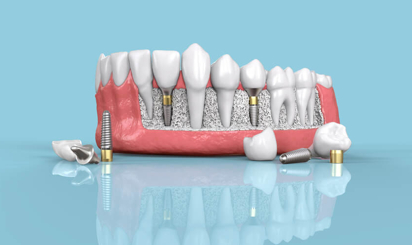 dental implants