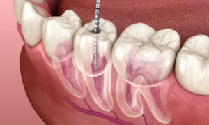 Root Canal Treatment