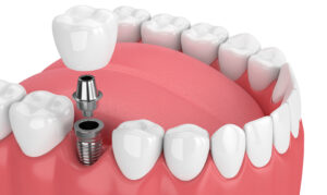 dental implants
