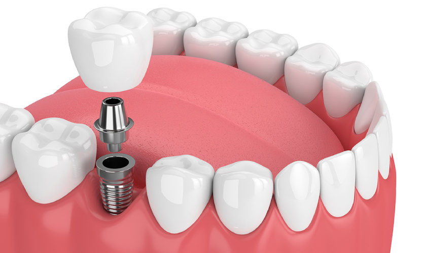 dental implants