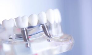 Dental Implants Colleyville - Serene Dental of Colleyville