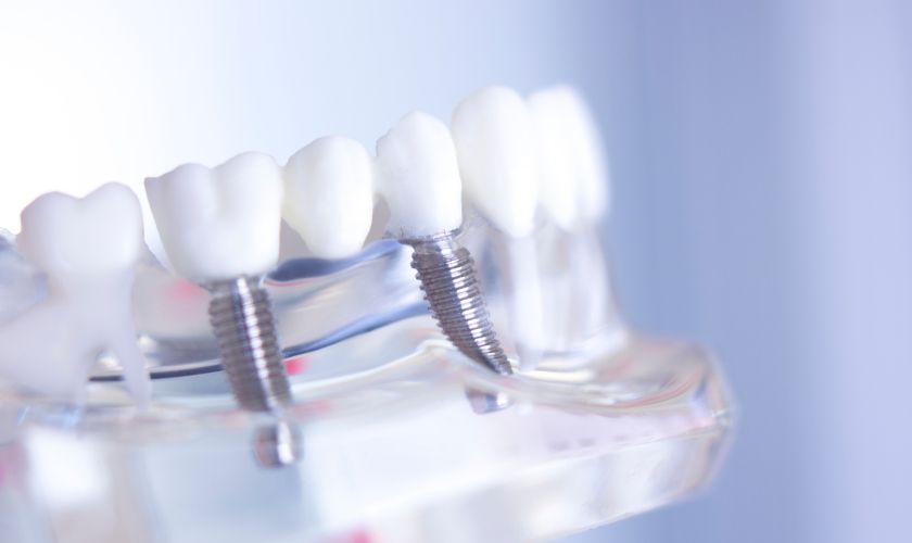 Dental Implants Colleyville – Serene Dental of Colleyville Dental Implants Colleyville - Serene Dental of Colleyville