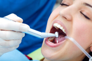 Tooth Extractions