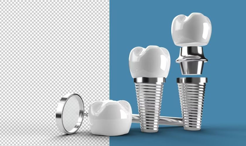 Dental implants xr:d:DAFvEIUsyaY:2,j:3720376885684717569,t:23092108