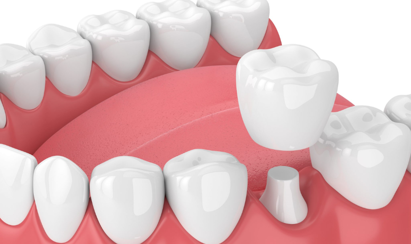 dental crown in colleyville