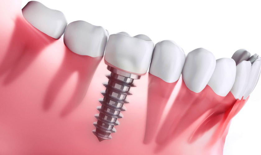 dental implants (2) dental implants (2)