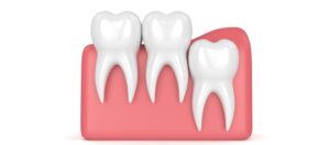 Wisdom Teeth Removal Colleyville, TX
