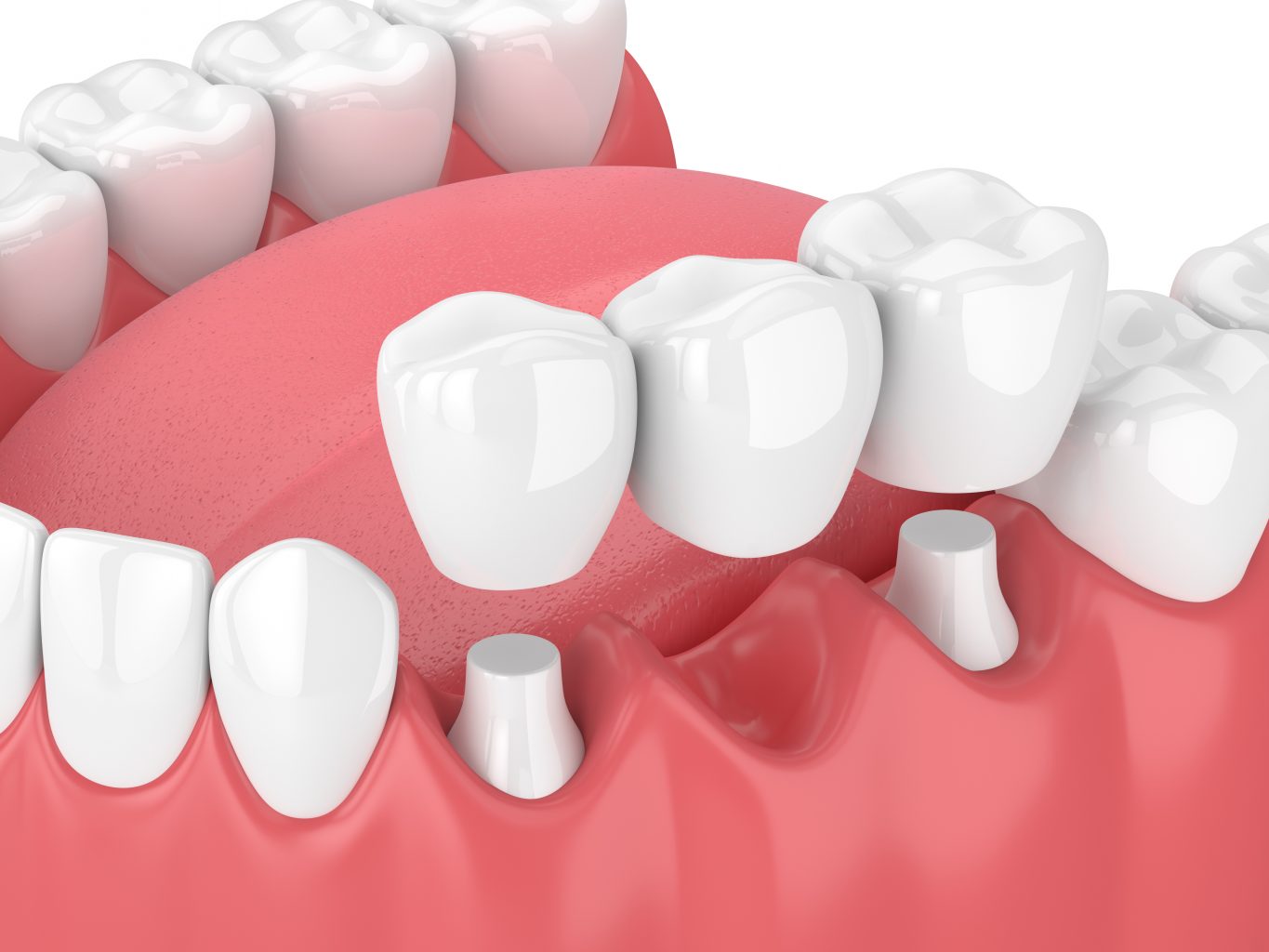 dental bridge in colleyville tx