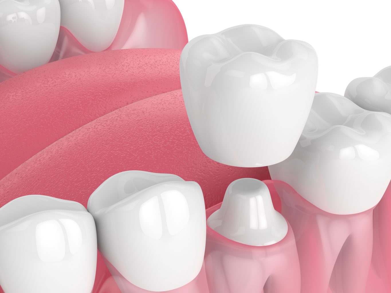 dental crowns in colleyville