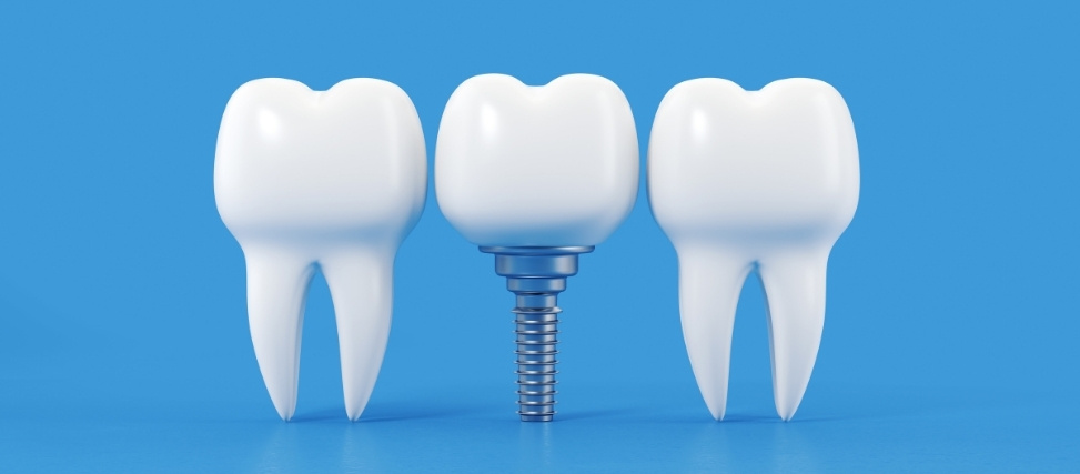signs you might be a good candidate for dental implants signs you might be a good candidate for dental implants