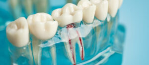 the role of fluoride in preventing root canals