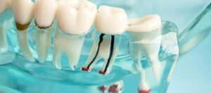 maintaining teeth after a root canal