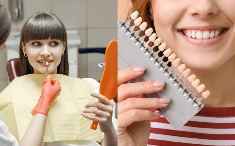 dental veneers or crowns dental veneers or crowns