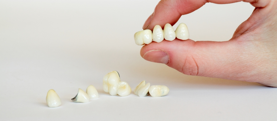 How Long Does A Dental Bridge Usually Last How Long Does A Dental Bridge Usually Last