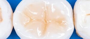 Can Tooth Decay Be Fixed With Fillings