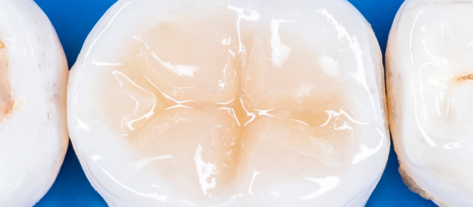 Can Tooth Decay Be Fixed With Fillings Can Tooth Decay Be Fixed With Fillings