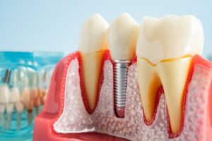 dental implants in Colleyville