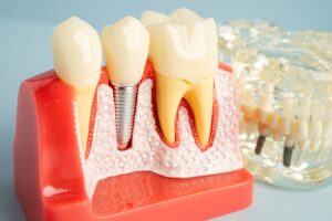 dental-implants-in-Colleyville-TX