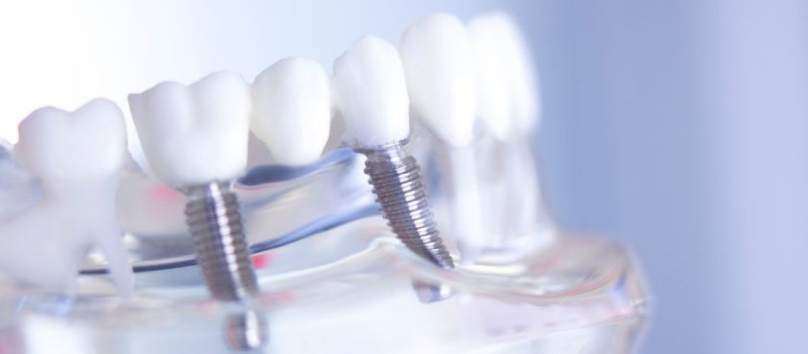 Dental Implants Colleyville - Serene Dental of Colleyville