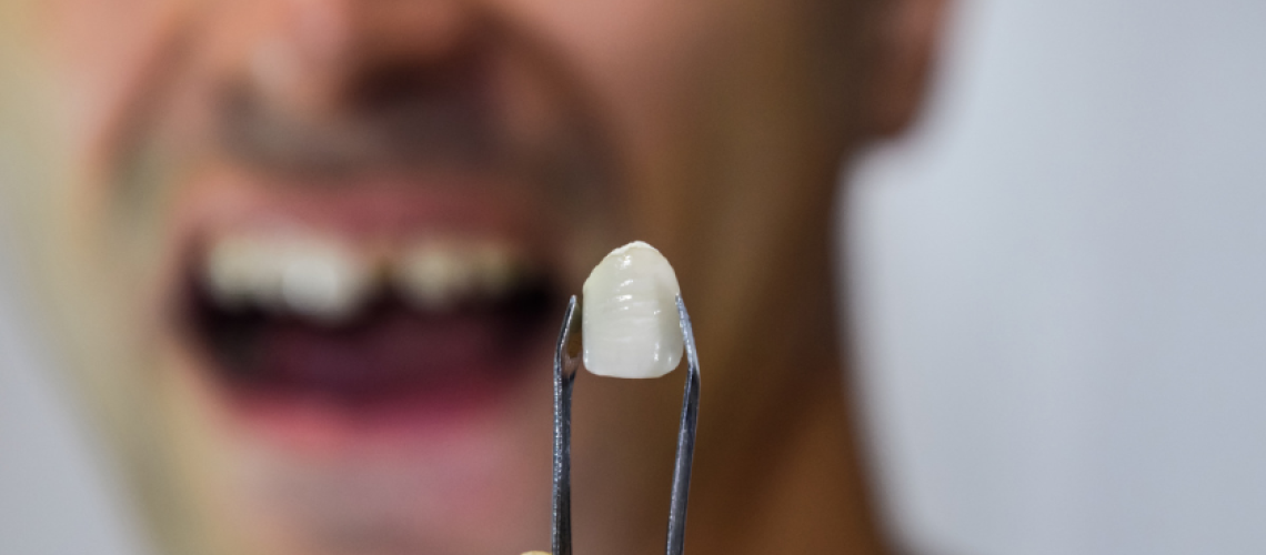 Replacing Lost tooth