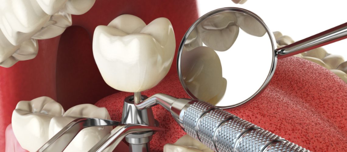 Dental Implant in Colleyville TX, Serene Dental of Colleyville