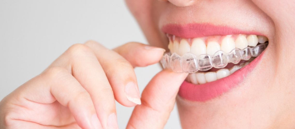 Invisalign in Colleyville TX, Serene Dental of Colleyville, Dentist, Dentist in Colleyville TX,