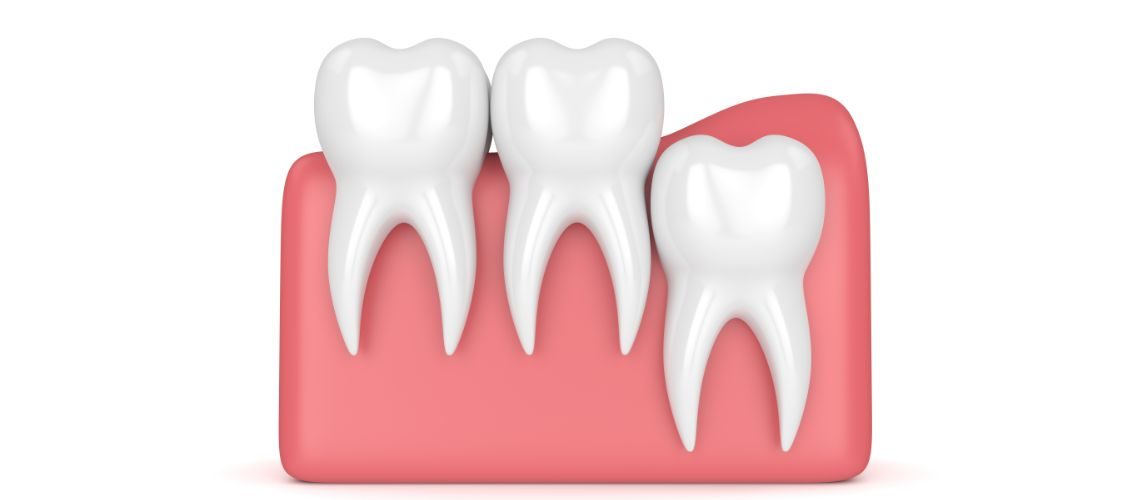 Wisdom Teeth Removal Colleyville, TX