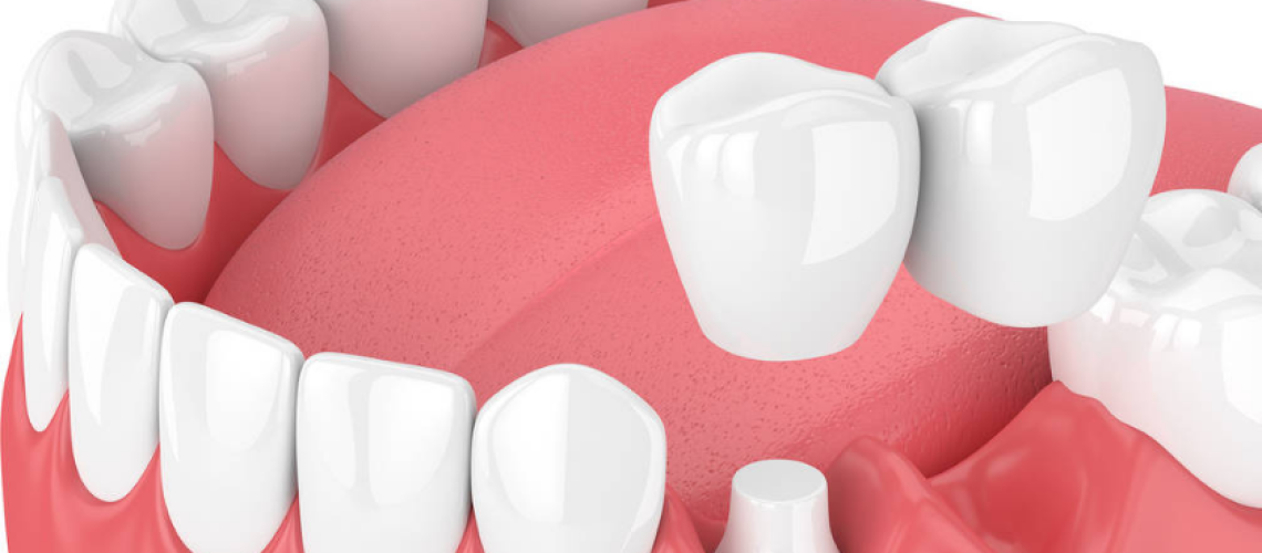 dental bridge