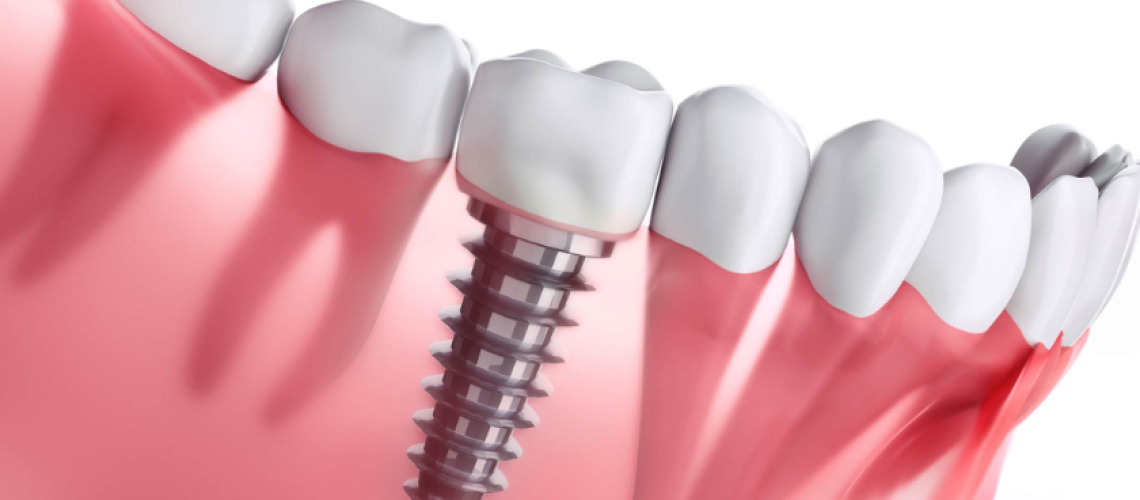 dental implants (2)