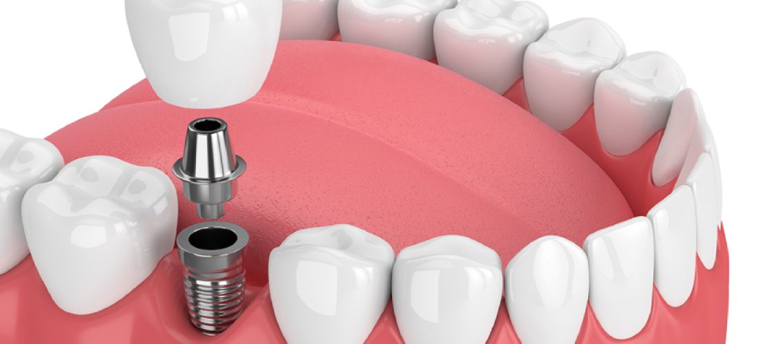 dental implants