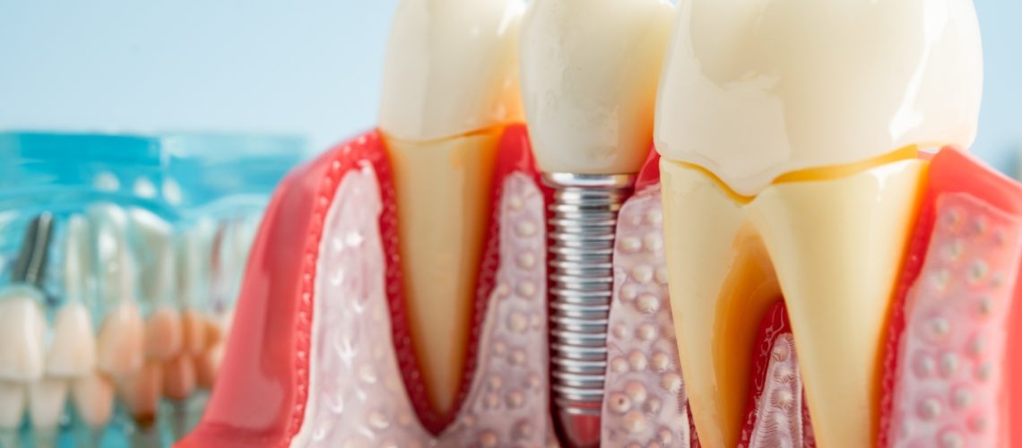dental implants in Colleyville