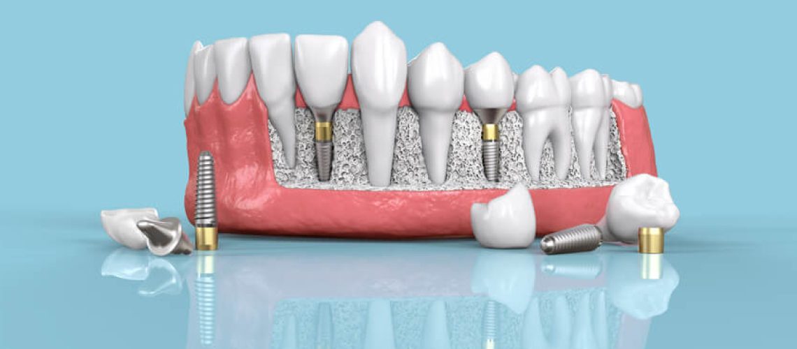 dental implants