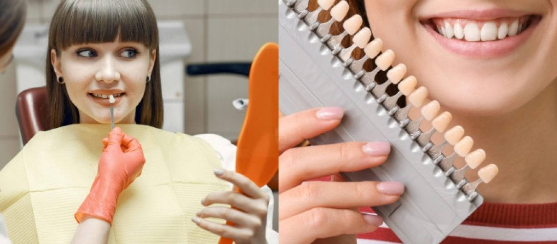 dental veneers or crowns