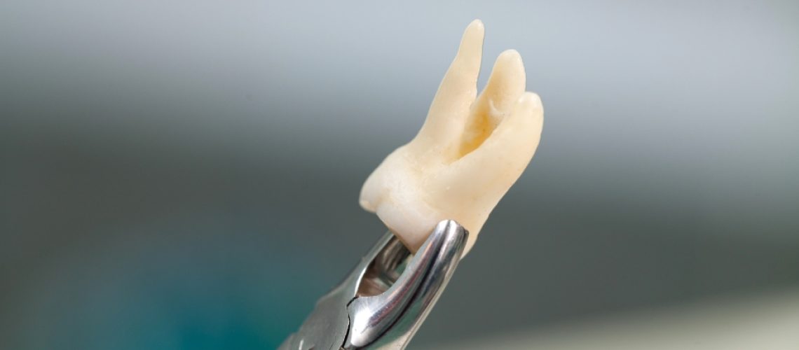 How do you know if you need wisdom teeth surgery