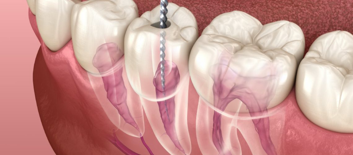 Root Canal Treatment