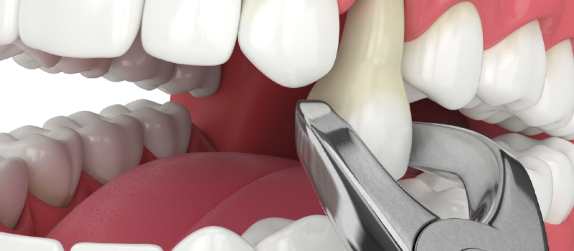 tooth extraction (1)