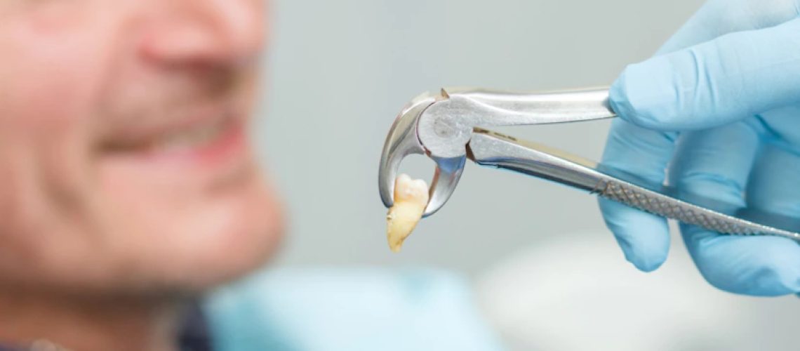 wisdom teeth removal